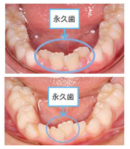 小児矯正01